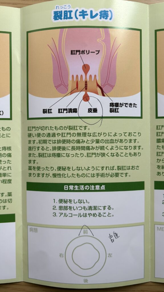 裂肛(キレ痔)と皮垂の説明パンフレット